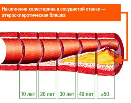 Појасни се који атеросклеротични плакови су одговорни за мождани удар