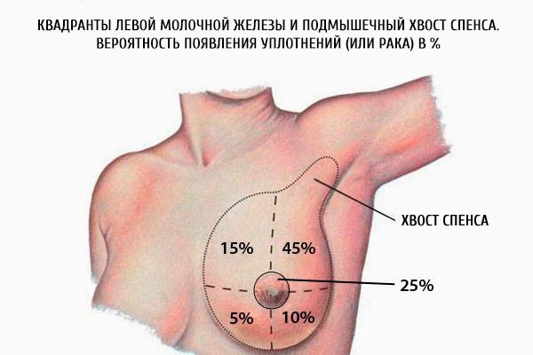 Квадранта леве дојке и аксиларна спенција спона.  Вероватноћа заптивања (или рака) у%