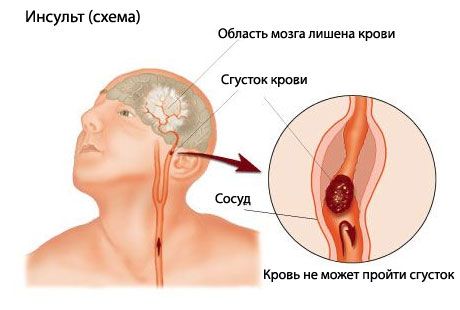 Једноставан тест предвиђа фатални удар