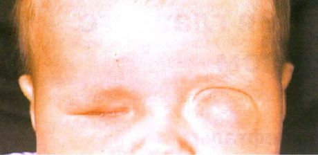 Микрофалт са истовременом формирањем цисте (лево око).  Анофталмус (десно око).