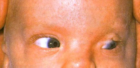 Фрасеров синдром.  Непотпуни криптофалмоси лијевог ока.