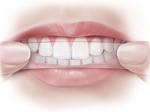 Како да користите бељење трака за зубе?