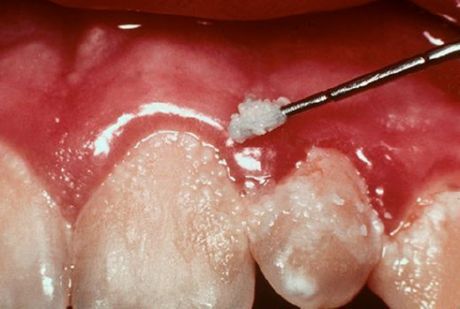 Зуби и гингивитис