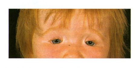 Двострани колобом очних капака код детета са Голденовим синдромом.  Затварање прореза са леве стране